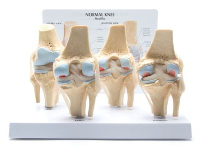 Anatomisch model van de knie, 4 stadia Osteoarthritis